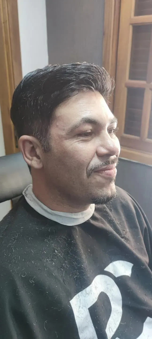 Acabamento lateral da prótese capilar, visto de perfil